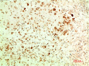 Immunohistochemical analysis of paraffin-embedded Human Ovarian Carcinoma Tissue using ATG5 Mouse mAb diluted at 1:200.