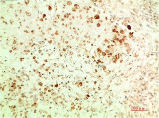 Immunohistochemical analysis of paraffin-embedded Human Ovarian Carcinoma Tissue using ATG5 Mouse mAb diluted at 1:200.