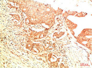 Immunohistochemical analysis of paraffin-embedded Human Breast Carcinoma Tissue using Acetyl P53(K382) Mouse mAb diluted at 1:200.