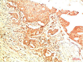 Immunohistochemical analysis of paraffin-embedded Human Breast Carcinoma Tissue using Acetyl P53(K382) Mouse mAb diluted at 1:200.