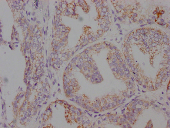 IHC image of CSB-MA546610 diluted at 1:100 and staining in paraffin-embedded human prostate cancer performed on a Leica BondTM system. After dewaxing and hydration, antigen retrieval was mediated by high pressure in a citrate buffer (pH 6.0). Sect...