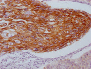 IHC image of CSB-MA550667 diluted at 1:100 and staining in paraffin-embedded human cervical cancer performed on a Leica BondTM system. After dewaxing and hydration, antigen retrieval was mediated by high pressure in a citrate buffer (pH 6.0). Sect...