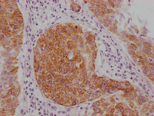 IHC image of CSB-MA589883 diluted at 1:100 and staining in paraffin-embedded human cervical cancer performed on a Leica BondTM system. After dewaxing and hydration, antigen retrieval was mediated by high pressure in a citrate buffer (pH 6.0). Sect...