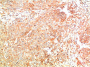 Immunohistochemical analysis of paraffin-embedded Human Breast Carcinoma Tissue using ATG7 Mouse mAb diluted at 1:200.