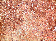 Immunohistochemical analysis of paraffin-embedded Human Lung Carcinoma Tissue using P38 Mouse mAb diluted at 1:200.
