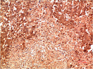 Immunohistochemical analysis of paraffin-embedded Human Lung Carcinoma Tissue using P38 Mouse mAb diluted at 1:200.