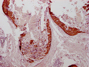 IHC image of CSB-MA634481 diluted at 1:100 and staining in paraffin-embedded human breast cancer performed on a Leica BondTM system. After dewaxing and hydration, antigen retrieval was mediated by high pressure in a citrate buffer (pH 6.0). Sectio...