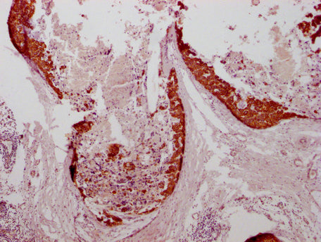 IHC image of CSB-MA634481 diluted at 1:100 and staining in paraffin-embedded human breast cancer performed on a Leica BondTM system. After dewaxing and hydration, antigen retrieval was mediated by high pressure in a citrate buffer (pH 6.0). Sectio...