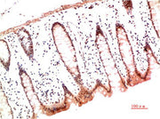 Immunohistochemical analysis of paraffin-embedded Human Colon Carcinoma Tissue using Collagen I Mouse mAb diluted at 1:200.