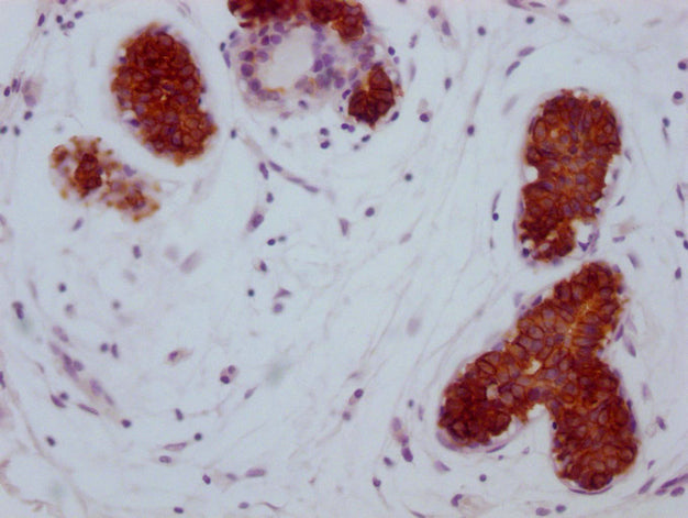 IHC image of CSB-MA785224 diluted at 1:100 and staining in paraffin-embedded human breast cancer performed on a Leica BondTM system. After dewaxing and hydration, antigen retrieval was mediated by high pressure in a citrate buffer (pH 6.0). Sectio...