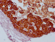 IHC image of CSB-MA789445 diluted at 1:100 and staining in paraffin-embedded human breast cancer performed on a Leica BondTM system. After dewaxing and hydration, antigen retrieval was mediated by high pressure in a citrate buffer (pH 6.0). Sectio...