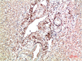Immunohistochemical analysis of paraffin-embedded Human Liver Carcinoma Tissue using TTR Mouse mAb diluted at 1:200.
