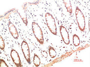 Immunohistochemical analysis of paraffin-embedded Human Colon Carcinoma Tissue using Collagen I Mouse mAb diluted at 1:200.