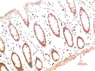 Immunohistochemical analysis of paraffin-embedded Human Colon Carcinoma Tissue using Collagen I Mouse mAb diluted at 1:200.