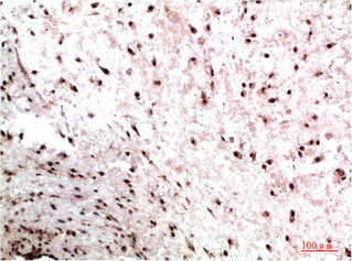 Immunohistochemical analysis of paraffin-embedded Human Colon Carcinoma Tissue using HP-1γ Mouse mAb diluted at 1:200.