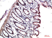Immunohistochemical analysis of paraffin-embedded Human Colon Carcinoma Tissue using HP-1γ Mouse mAb diluted at 1:200.