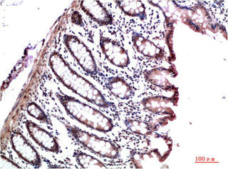 Immunohistochemical analysis of paraffin-embedded Human Colon Carcinoma Tissue using HP-1γ Mouse mAb diluted at 1:200.