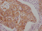 IHC image of CSB-MA898464 diluted at 1:100 and staining in paraffin-embedded human cervical cancer performed on a Leica BondTM system. After dewaxing and hydration, antigen retrieval was mediated by high pressure in a citrate buffer (pH 6.0). Sect...