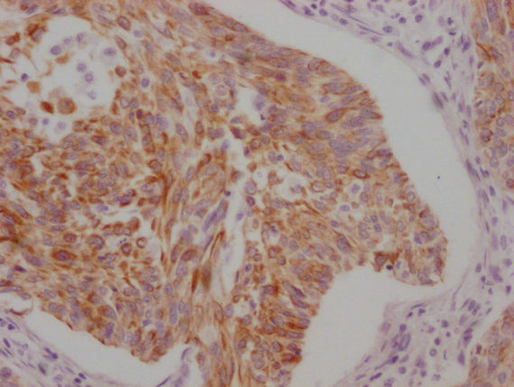 IHC image of CSB-MA898464 diluted at 1:100 and staining in paraffin-embedded human cervical cancer performed on a Leica BondTM system. After dewaxing and hydration, antigen retrieval was mediated by high pressure in a citrate buffer (pH 6.0). Sect...