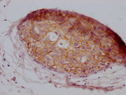 IHC image of CSB-MA907551 diluted at 1:100 and staining in paraffin-embedded human breast cancer performed on a Leica BondTM system. After dewaxing and hydration, antigen retrieval was mediated by high pressure in a citrate buffer (pH 6.0). Sectio...