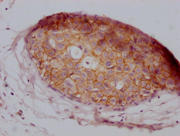 IHC image of CSB-MA907551 diluted at 1:100 and staining in paraffin-embedded human breast cancer performed on a Leica BondTM system. After dewaxing and hydration, antigen retrieval was mediated by high pressure in a citrate buffer (pH 6.0). Sectio...