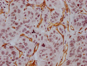 IHC image of CSB-MA918107 diluted at 1:100 and staining in paraffin-embedded human liver cancer performed on a Leica BondTM system. After dewaxing and hydration, antigen retrieval was mediated by high pressure in a citrate buffer (pH 6.0). Section...