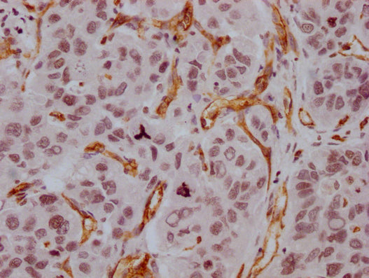 IHC image of CSB-MA918107 diluted at 1:100 and staining in paraffin-embedded human liver cancer performed on a Leica BondTM system. After dewaxing and hydration, antigen retrieval was mediated by high pressure in a citrate buffer (pH 6.0). Section...