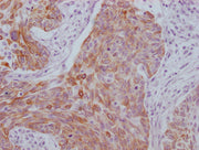IHC image of CSB-MA949708 diluted at 1:100 and staining in paraffin-embedded human cervical cancer performed on a Leica BondTM system. After dewaxing and hydration, antigen retrieval was mediated by high pressure in a citrate buffer (pH 6.0). Sect...