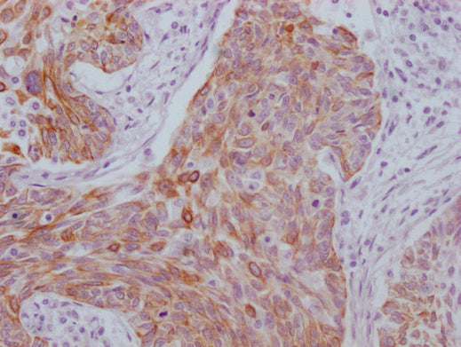 IHC image of CSB-MA949708 diluted at 1:100 and staining in paraffin-embedded human cervical cancer performed on a Leica BondTM system. After dewaxing and hydration, antigen retrieval was mediated by high pressure in a citrate buffer (pH 6.0). Sect...