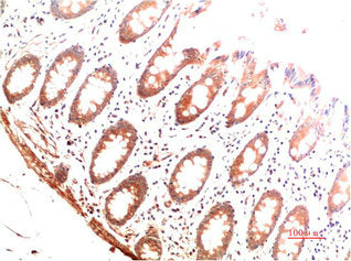 Immunohistochemical analysis of paraffin-embedded Human Colon Carcinoma Tissue using Collagen I Mouse mAb diluted at 1:200.