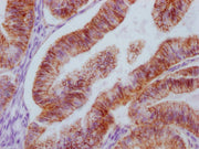 IHC image of CSB-MA963136 diluted at 1:100 and staining in paraffin-embedded human endometrial cancer performed on a Leica BondTM system. After dewaxing and hydration, antigen retrieval was mediated by high pressure in a citrate buffer (pH 6.0). S...
