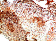 Immunohistochemical analysis of paraffin-embedded Human Lung Carcinoma Tissue using Collagen II Mouse mAb diluted at 1:200.