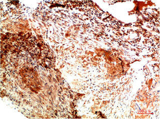 Immunohistochemical analysis of paraffin-embedded Human Lung Carcinoma Tissue using Collagen II Mouse mAb diluted at 1:200.