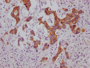 IHC image of CSB-MA974483 diluted at 1:100 and staining in paraffin-embedded human gastric cancer performed on a Leica BondTM system. After dewaxing and hydration, antigen retrieval was mediated by high pressure in a citrate buffer (pH 6.0). Secti...