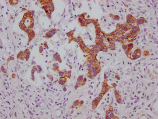 IHC image of CSB-MA974483 diluted at 1:100 and staining in paraffin-embedded human gastric cancer performed on a Leica BondTM system. After dewaxing and hydration, antigen retrieval was mediated by high pressure in a citrate buffer (pH 6.0). Secti...