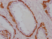 IHC image of CSB-MA986157 diluted at 1:100 and staining in paraffin-embedded human prostate cancer performed on a Leica BondTM system. After dewaxing and hydration, antigen retrieval was mediated by high pressure in a citrate buffer (pH 6.0). Sect...