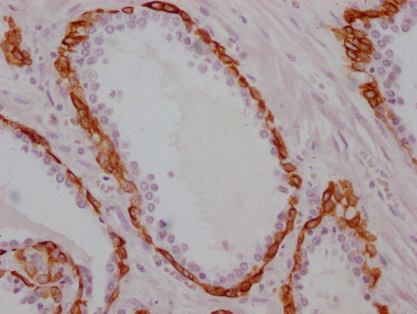 IHC image of CSB-MA986157 diluted at 1:100 and staining in paraffin-embedded human prostate cancer performed on a Leica BondTM system. After dewaxing and hydration, antigen retrieval was mediated by high pressure in a citrate buffer (pH 6.0). Sect...