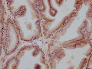 IHC image of CSB-MA999605 diluted at 1:100 and staining in paraffin-embedded human prostate cancer performed on a Leica BondTM system. After dewaxing and hydration, antigen retrieval was mediated by high pressure in a citrate buffer (pH 6.0). Sect...