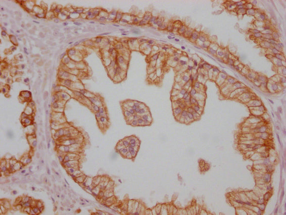 IHC image of CSB-MA999890 diluted at 1:100 and staining in paraffin-embedded human prostate cancer performed on a Leica BondTM system. After dewaxing and hydration, antigen retrieval was mediated by high pressure in a citrate buffer (pH 6.0). Sect...