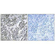 Immunohistochemistry analysis of paraffin-embedded human lung carcinoma tissue using ATP5D antibody.