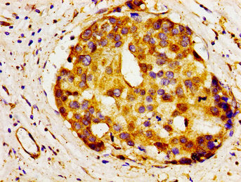 Immunohistochemistry of paraffin-embedded human breast cancer using CSB-PA001001LA01HU at dilution of 1:100