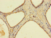 Immunohistochemistry of paraffin-embedded human prostate cancer using CSB-PA001014LA01HU at dilution of 1:100