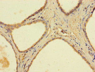 Immunohistochemistry of paraffin-embedded human prostate cancer using CSB-PA001014LA01HU at dilution of 1:100