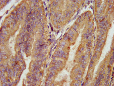 IHC image of CSB-PA001023LA01HU diluted at 1:100 and staining in paraffin-embedded human endometrial cancer performed on a Leica BondTM system. After dewaxing and hydration, antigen retrieval was mediated by high pressure in a citrate buffer (pH 6...