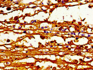 Immunohistochemistry of paraffin-embedded human melanoma using CSB-PA001050LA01HU at dilution of 1:100