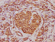 IHC image of CSB-PA001075LA01HU diluted at 1:100 and staining in paraffin-embedded human pancreatic cancer performed on a Leica BondTM system. After dewaxing and hydration, antigen retrieval was mediated by high pressure in a citrate buffer (pH 6....