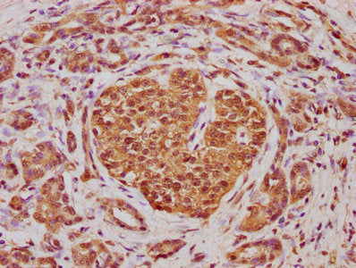 IHC image of CSB-PA001075LA01HU diluted at 1:100 and staining in paraffin-embedded human pancreatic cancer performed on a Leica BondTM system. After dewaxing and hydration, antigen retrieval was mediated by high pressure in a citrate buffer (pH 6....
