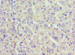 Immunohistochemistry of paraffin-embedded human liver cancer using CSB-PA001117ESR2HU at dilution of 1:100