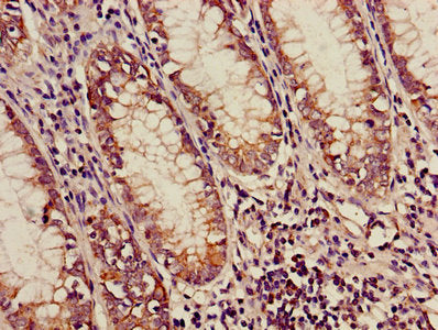 Immunohistochemistry of paraffin-embedded human colon cancer using CSB-PA001126LA01HU at dilution of 1:100