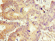 Immunohistochemistry of paraffin-embedded human colon cancer using CSB-PA001169ESR2HU at dilution of 1:100